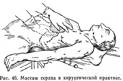 Массаж сердца в хирургической практике